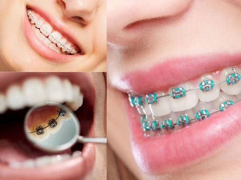 लगवाने हैं दातों में तार?